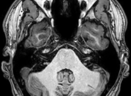 IRM d'un cerveau humain normal