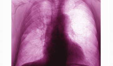 Radiographie de poumons atteints de pneumonie