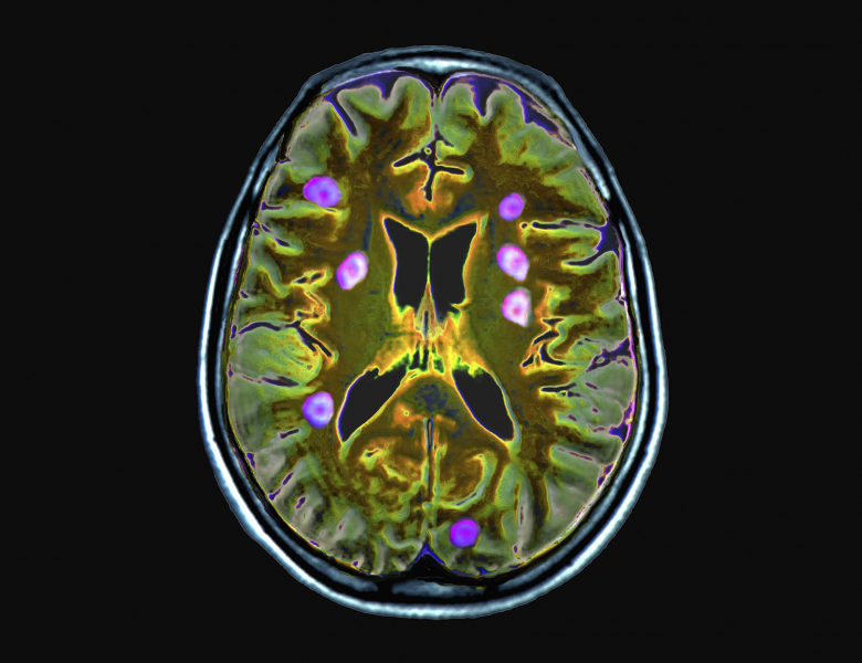 Cliché d'un cerveau par IRM avec agent de contraste