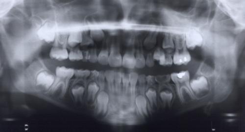 Radiographie panoramique dentaire d’un enfant.