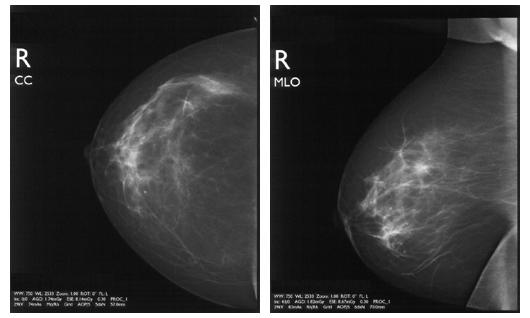 Mammographie de contrôle.