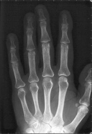 Radiographie récente d’une main.