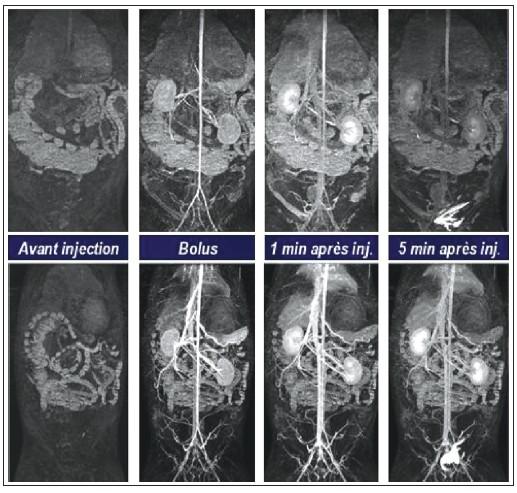 Angiographies avec deux agents de contraste différents, le Dotarem® (0,1 mmol.kg–1) en haut et le Vistarem® (0,015 mmol.kg–1) en bas. Bolus = injection intraveineuse d’une dose importante de l’agent de contraste.