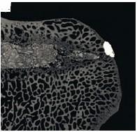 On distingue, au microscope, ce type de médicament implanté sur un os de brebis.