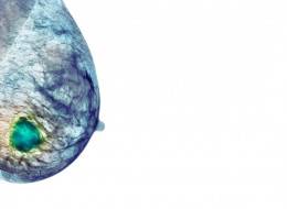 Radiographie d'un sein porteur d'une tumeur