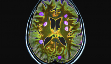 Cliché d'un cerveau par IRM avec agent de contraste