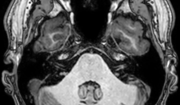 IRM d'un cerveau humain normal
