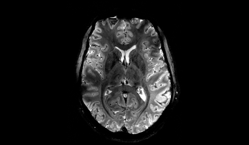 Cliché IRM d'un cerveau avec un champ magnétique à 11 Teslas