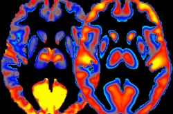 Clichés obtenus par combinaison du TEP-scan et de l'IRM