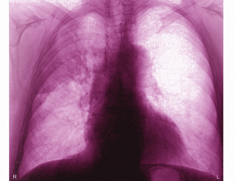 Radiographie de poumons atteints de pneumonie